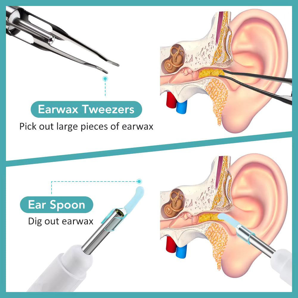 Smart Wi-Fi Visual Earwax Cleaner & Tweezer Set with 1080P HD Otoscope Camera